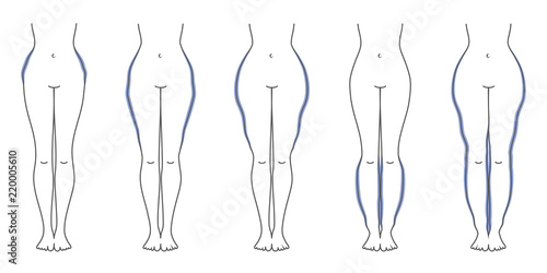 Schaubild Lipödem Flieder