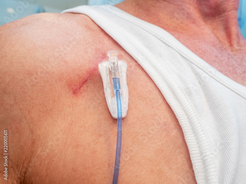 Tube for intravenous fluids injections to implantable port for chemotherapy photo