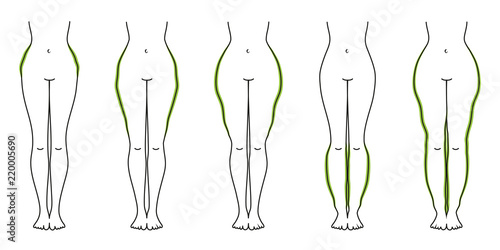 Schaubild Lipödem Grün