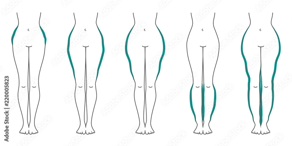 Schaubild Lipödem Türkis Schaubild Lipödem Türkis
