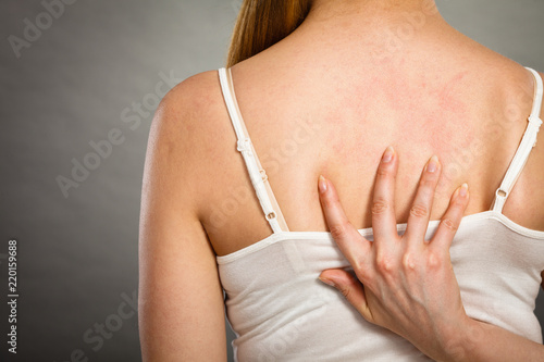 woman scratching her itchy back with allergy rash photo