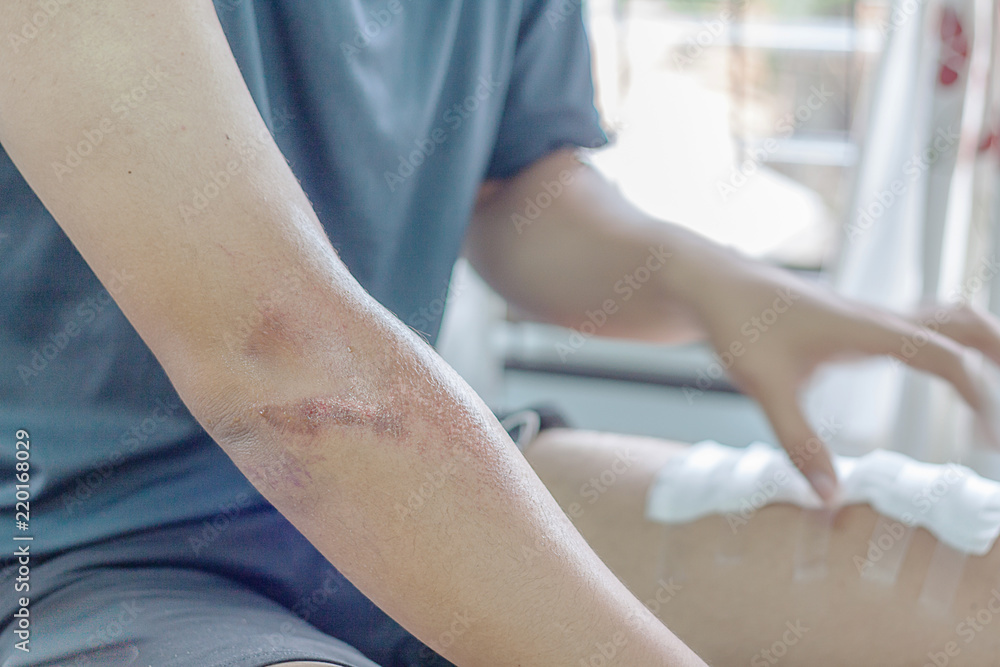 abrasion wound abrasion wound