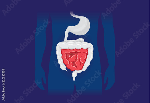 Illustration about abnormal symptom of human small Intestines. Disease about Digestive system.
