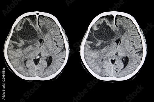 metastatic brain tumor