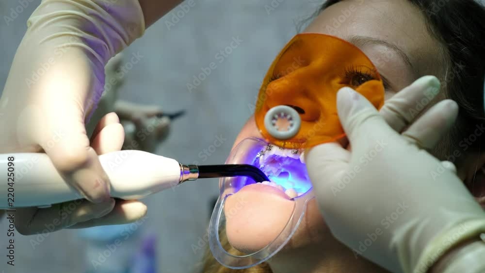 Assistant shines with a dental polymerization ultraviolet lamp to fixation the brackets close-up. Visit to the dentist, installation of the bracket system Assistant shines with a dental polymerization ultraviolet lamp to fixation the brackets close-up. Visit to the dentist, installation of the bracket system
