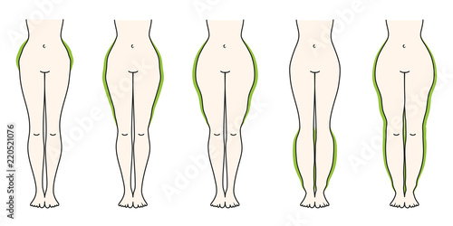 Schaubild Lipödem Grün