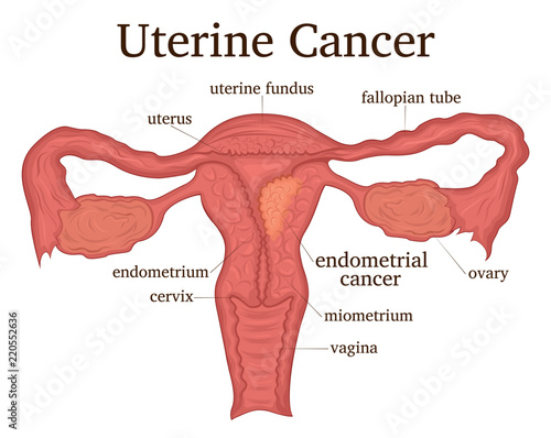 Illustration of uterine cancer