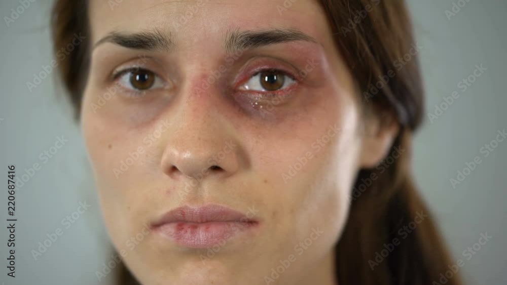 Hurt lady crying, bruised face close-up, domestic violence issue, awareness