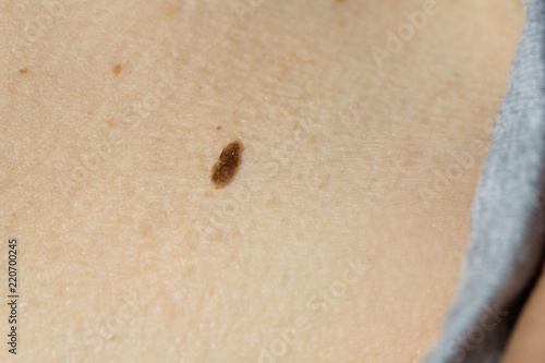 Close-up of skin mole
