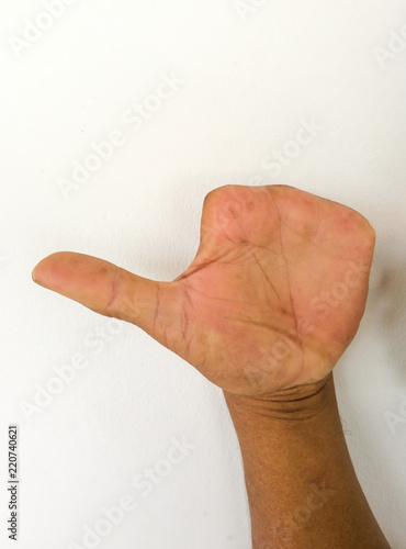 Amputate finger of people from accident.