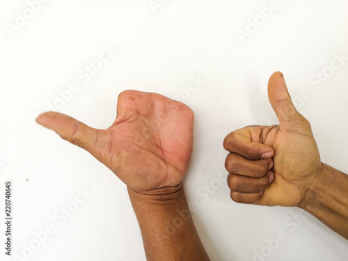 Amputate finger of people from accident.