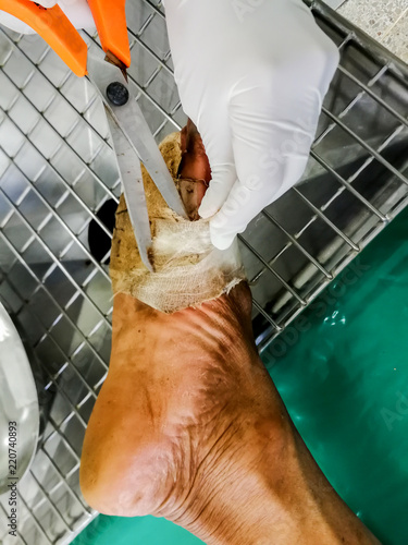 Close up of infected wound with diabetes foot that turn into necrotizing fasciitis or Flesh-eating disease , a severe infectious disease that need urgent surgical treatment.Blurred focus