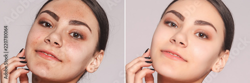 health, people, youth and beauty concept - Before and after cosmetic operation. Young pretty woman portrait. Before and after cosmetic or plastic procedure anti-age therapy, treatment