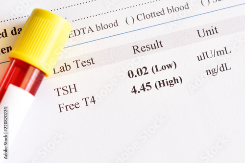 Blood sample tube with abnormal thyroid hormone test result  photo