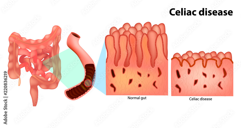 ceiliac 