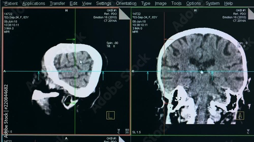 Brain scanning process displayed on a monitor photo