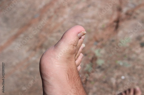 Closeup of a human foot and toes with cracked and peeling toe nails. © mynewturtle
