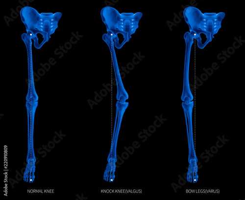 Alignment types of disease lower half limbs or leg bone problem- normal- knock knee- bowlegs or valgus- varus knee- 3D- human anatomy- medical diagram- educational concept- x-ray blue film color