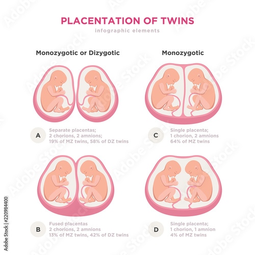 Twin types infographic elements in flat design. Monozygotic or Dizygotic Placentation of twins medical illustration and icons isolated on white background.