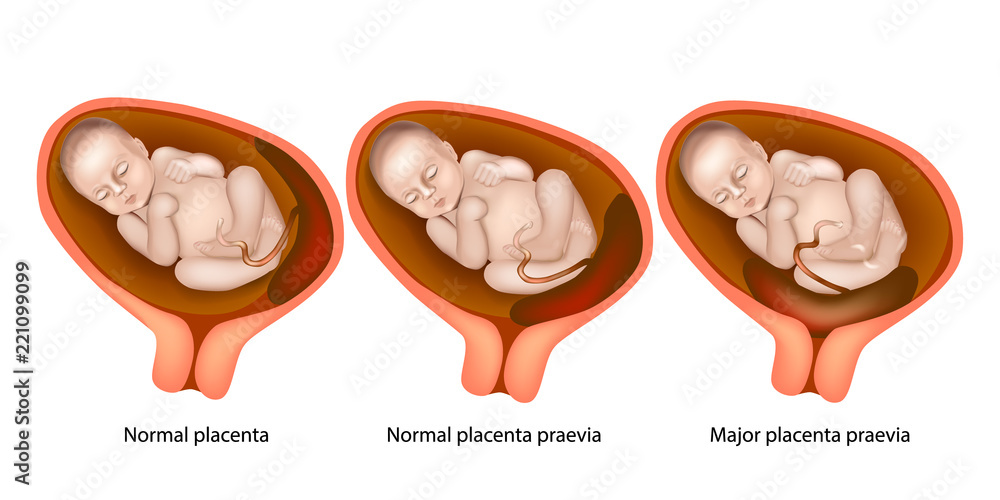 Different Placental Locations During Pregnancy ( Major placenta previa and Normal placenta