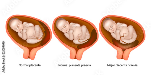 Different Placental Locations During Pregnancy ( Major placenta previa and
Normal placenta previa) photo