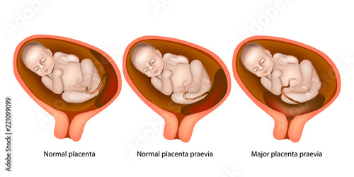 Different Placental Locations During Pregnancy ( Major placenta previa and
Normal placenta previa)