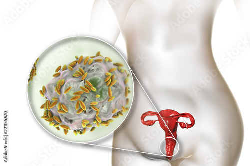 Bacterial vaginosis. Vaginal secretions contain epithelial cells, so-called clue cells covered with bacteria Gardnerella vaginalis, 3D illustration photo