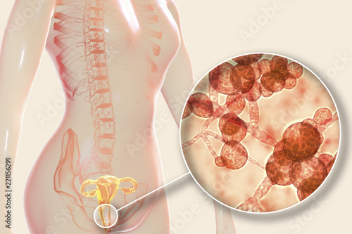 Vaginal thrush, female candidiasis, 3D illustration showing fungal vaginitis and close-up view of yeast fungi Candida auris photo