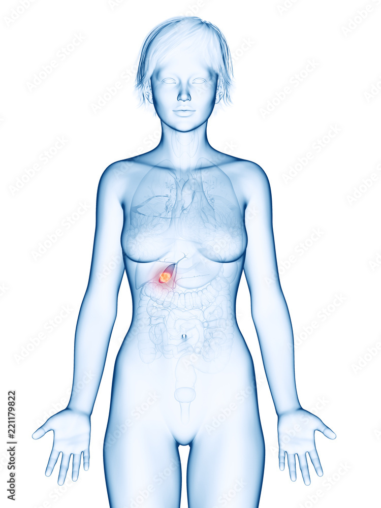Fototapeta premium medically accurate 3d rendering of a female´s gallbladder cancer