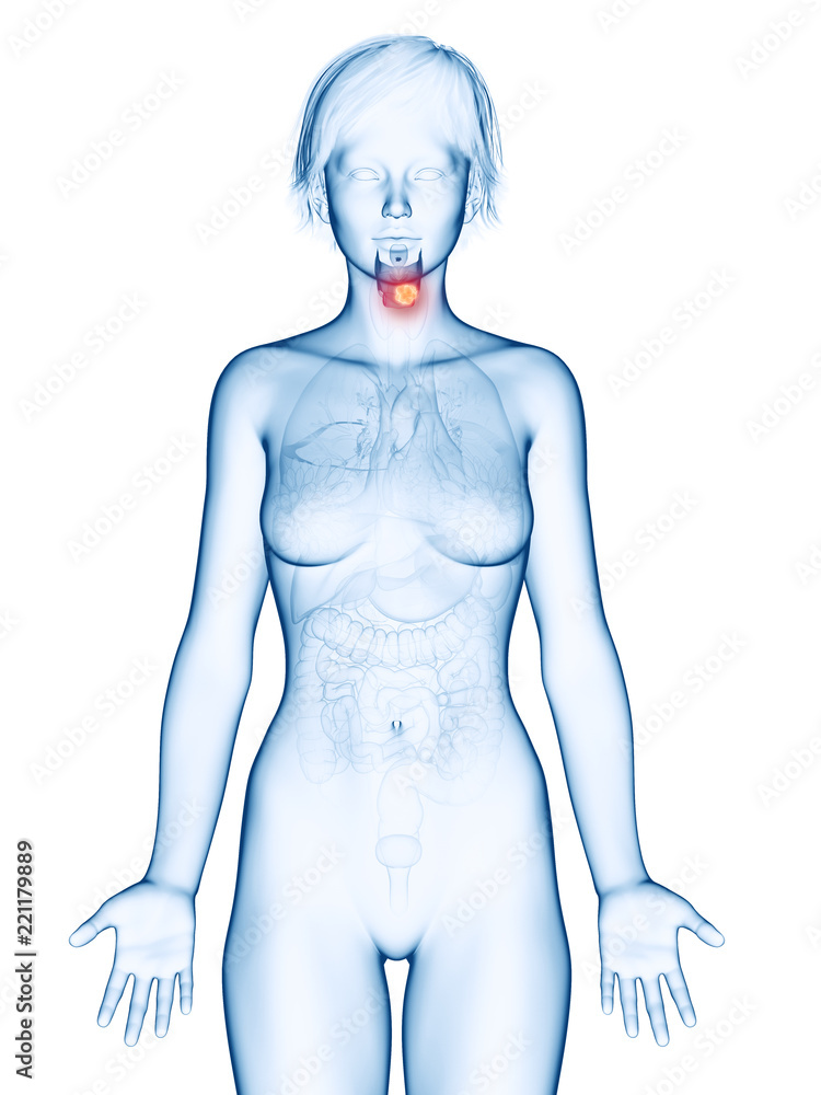 Fototapeta premium medically accurate 3d rendering of a female´s larynx cancer