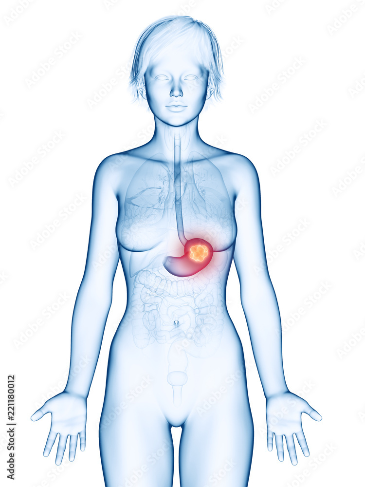 Naklejka premium medically accurate 3d rendering of a female´s stomach cancer
