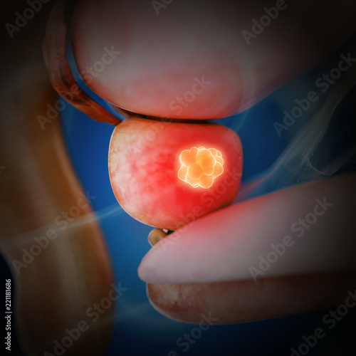 Plakat w ramie 3d rendered medically accurate illustration of prostate cancer