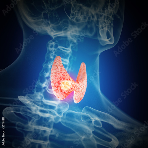 Fototapeta Naklejka Na Ścianę i Meble -  3d rendered medically accurate illustration of thyroid cancer