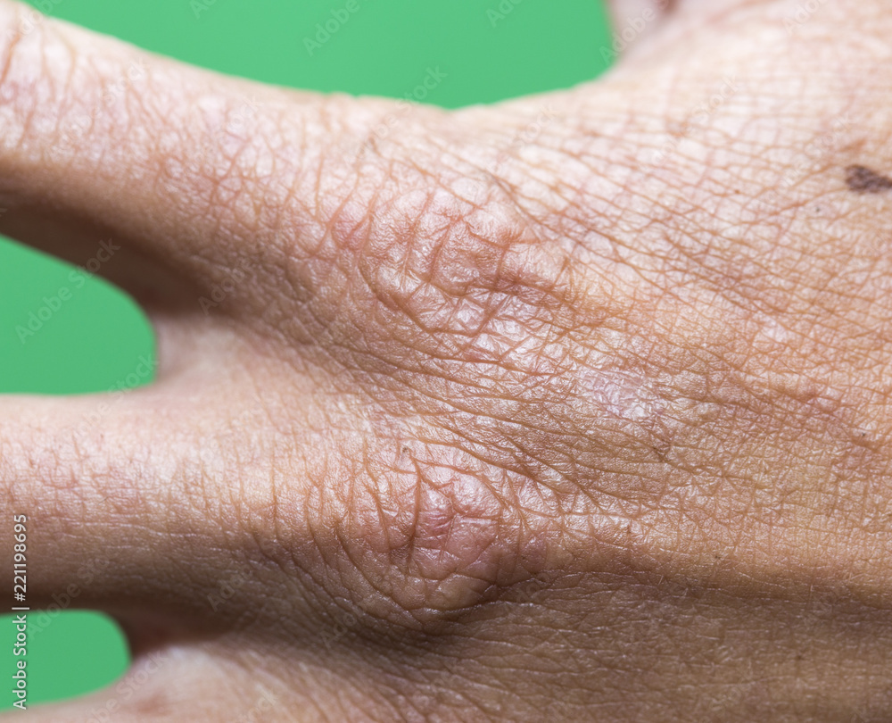Fototapeta premium hand of a man with a scar of a macro
