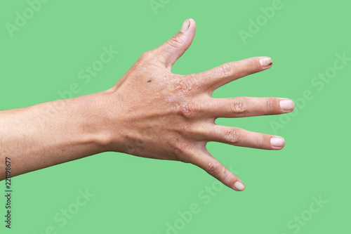 hand of a man with a scar isolated on a green background