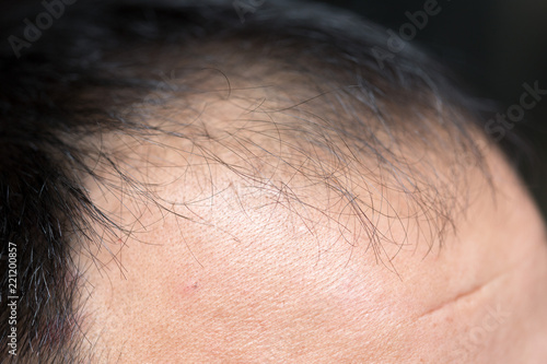 A middle-aged man with hair loss. Baldness