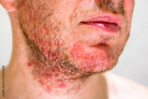 Detail of man's chin with seborrheic dermatitis in the beard area photo