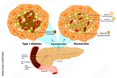 The pancreas has many islets that contain insulin-producing beta cells and glucagon-producing. Type 1 diabetes ( Beta cell destroyed).  photo