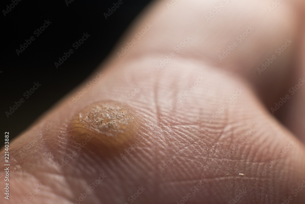 Fototapeta premium Verruca on hand, wart freeze concept, selective focus