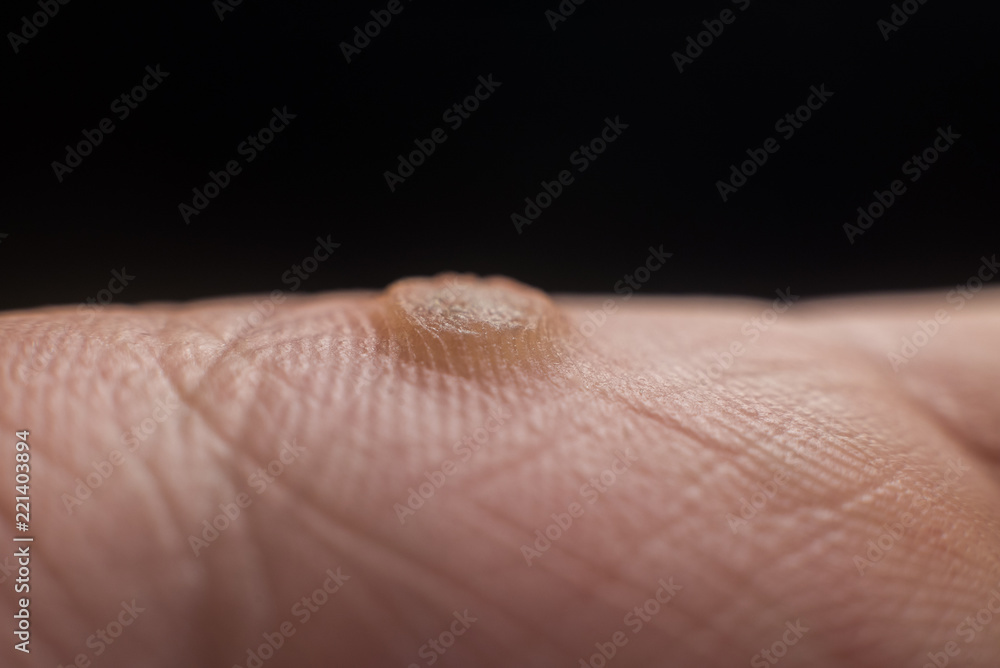 Fototapeta premium Verruca on hand, wart freeze concept, selective focus