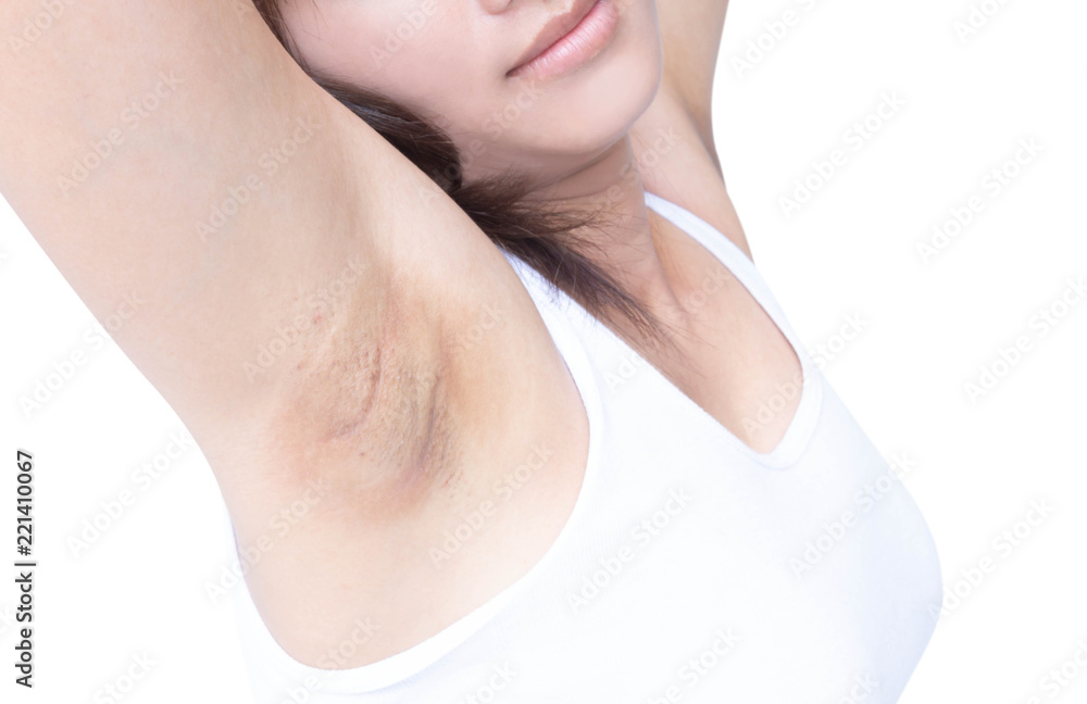 Women problem black armpit on white background for skin care and beauty concept Women problem black armpit on white background for skin care and beauty concept