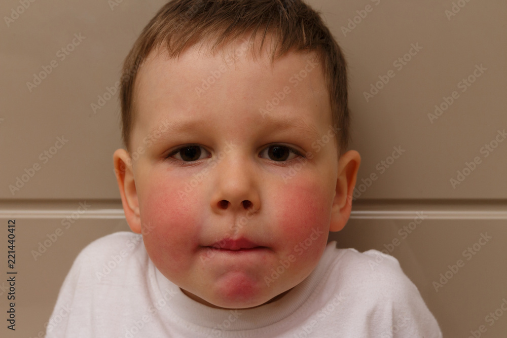 the boy has red cheeks, a rash on his cheeks in the child, a rash on