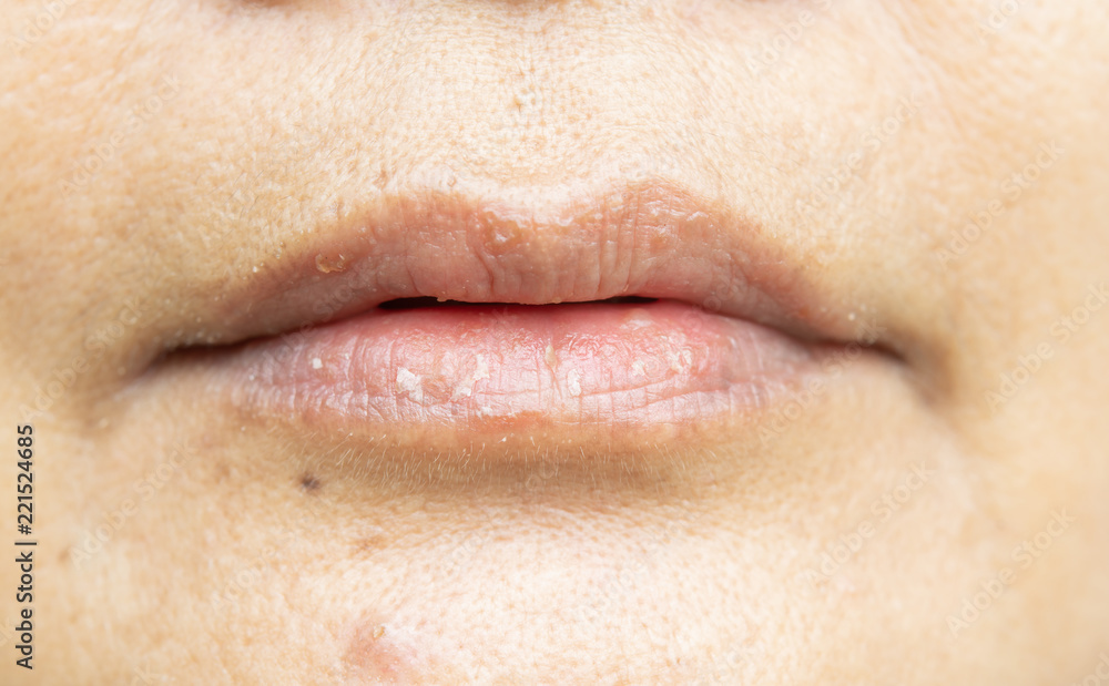 Dry lips and peeling Dry lips and peeling