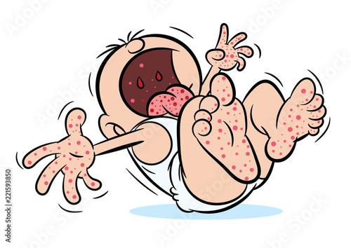 Crying baby with hand, foot and mouth disease or HFMD illustration photo