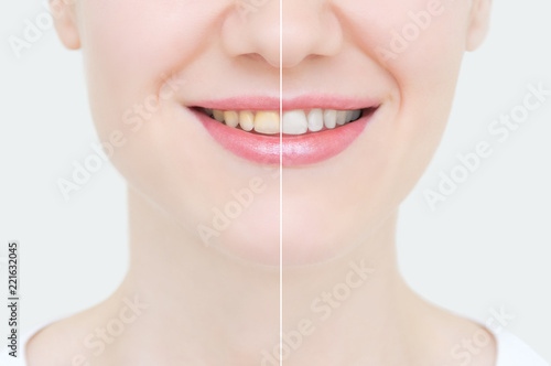 Perfect smile before and after bleaching. Dental care and whitening teeth.Face close-up.