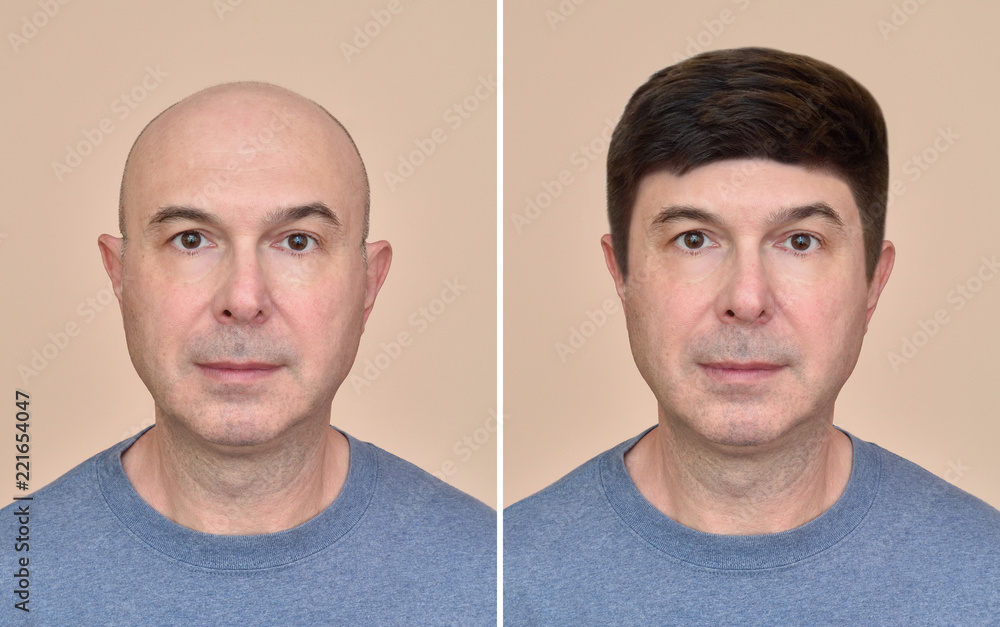 Two portraits of a same middle aged bald man before and after wearing wig Two portraits of a same middle aged bald man before and after wearing wig