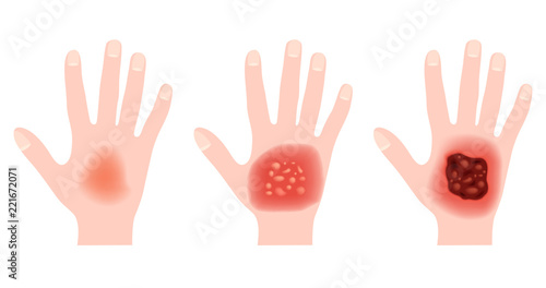 step of burn . Normal to serious burn skin . vector and icon / hand photo