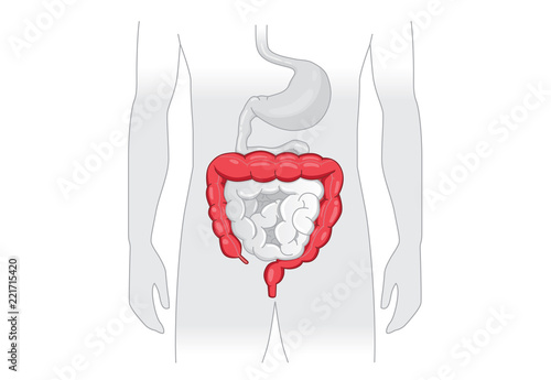 Illustration about abnormal symptom of human large Intestine. Disease about Digestive system.