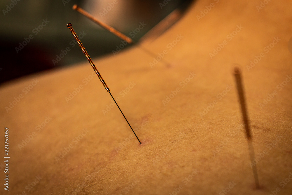 Approach of an acupuncture needle inserted in the neck of a patient. Approach of an acupuncture needle inserted in the neck of a patient.