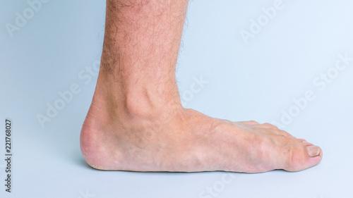 The left leg of a man with signs of joint disease and flat feet.